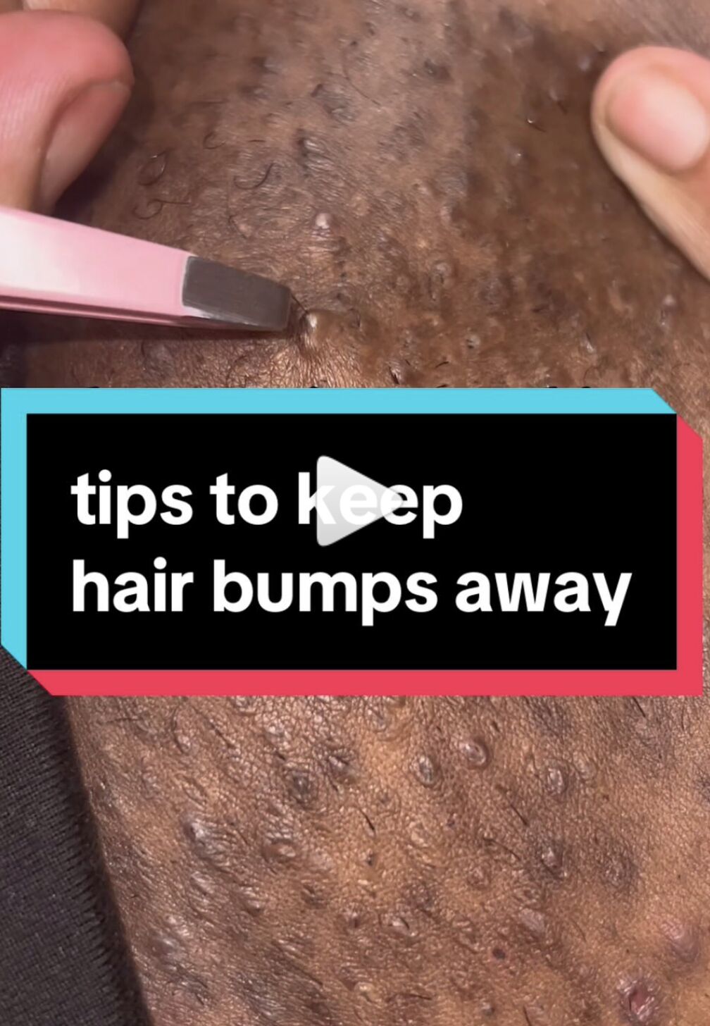 How to get rid deals of hair bumps